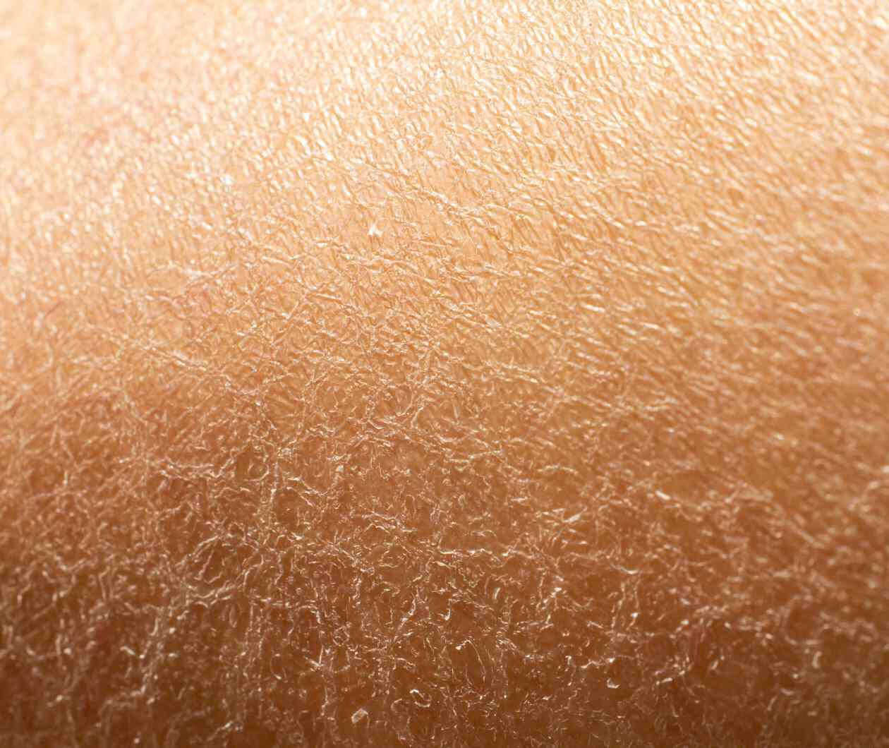 Compromised Skin Barrier